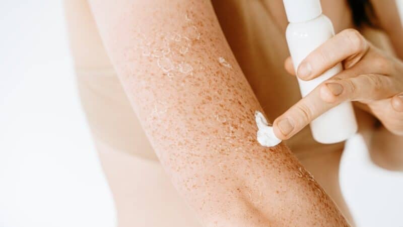 Przebarwienia posłoneczne – jak sobie z nimi poradzić?