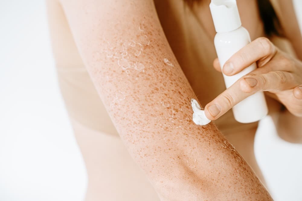 Przebarwienia posłoneczne – jak sobie z nimi poradzić?